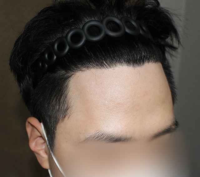 시술 이후 사진