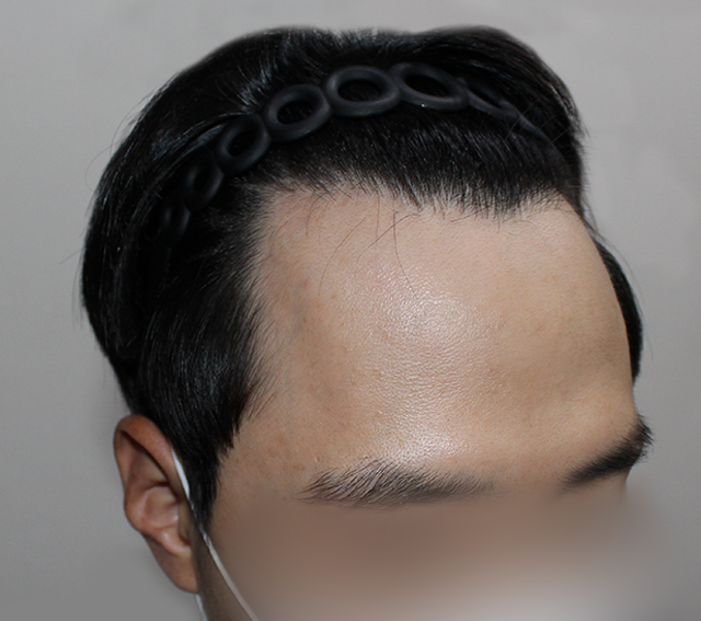 시술 이전 사진